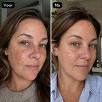 Arbutin 7% + Tranexamic Acid 4% Cream